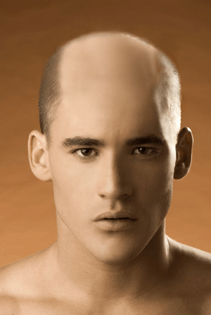 Hair Restoration for men 